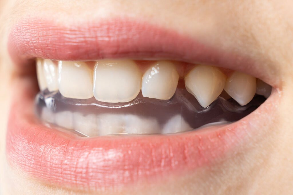 occlusal night guard dental care Flemington NJ